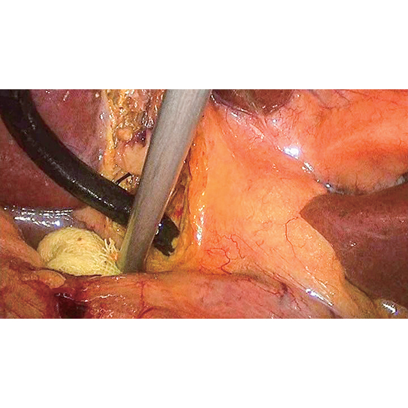 10 мм HD Laparoscope 